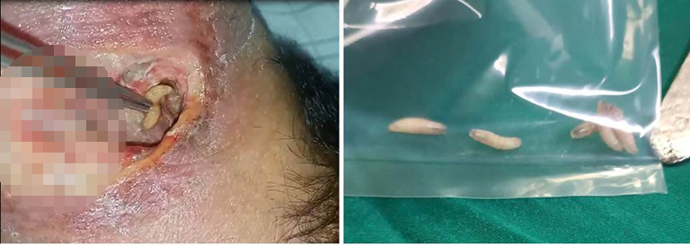 Rùng mình: Giòi bò lổn nhổn bên trong vết thương vùng cổ