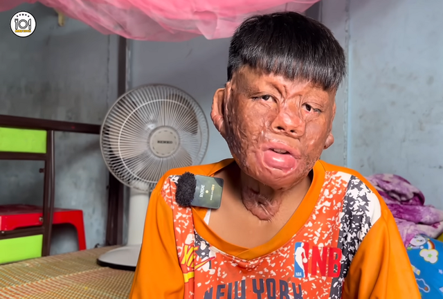 Cậu bé được ủng hộ hơn 1 tỷ khi bị bỏng vì cứu mẹ nuôi “vui đến mất ngủ”