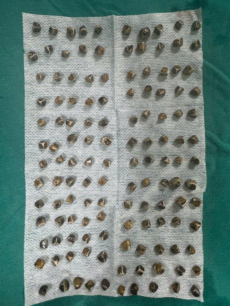 Mổ cấp cứu nữ bệnh nhân có hơn 100 viên sỏi chứa đầy trong túi mật