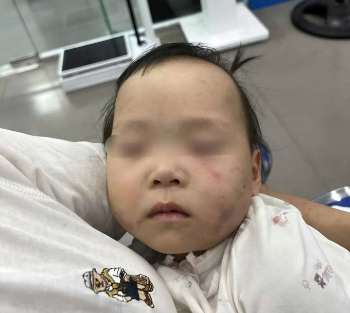 Bé gái 1 tuổi bị bầm tím mặt khi gửi nhà trẻ ở Bắc Ninh: Công an tạm giữ cô giáo