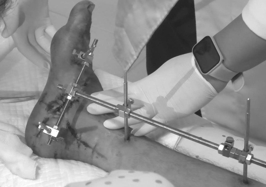 Nối bàn chân đứt lìa cho người đàn ông bị tai nạn máy cắt cỏ