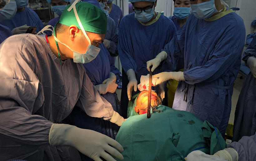 Cấp cứu nam sinh ở Nghệ An bị thanh sắt dài 50cm đâm xuyên qua đầu và mặt