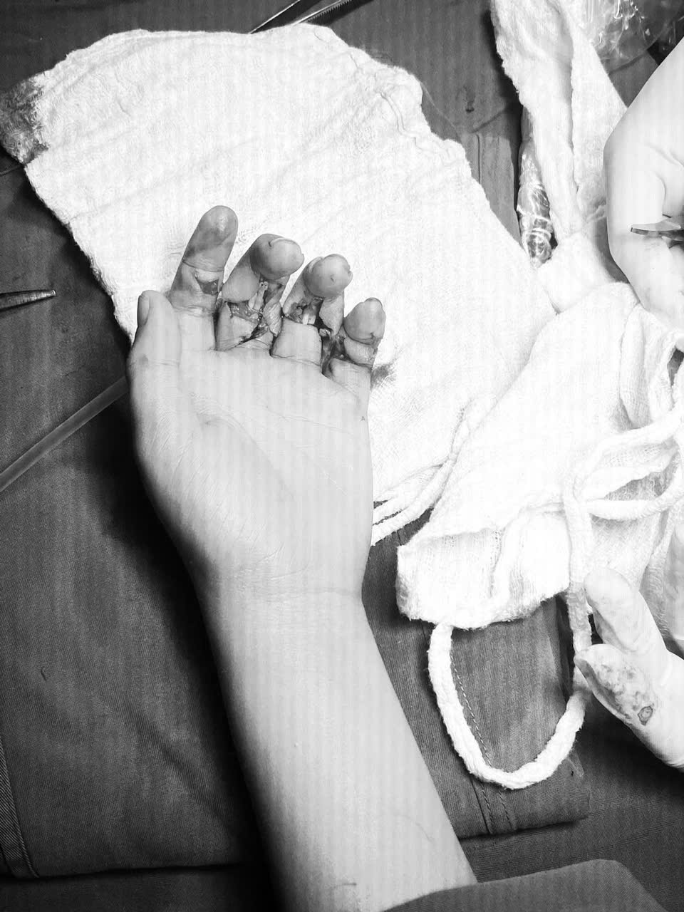 PHẪU THUẬT NỐI GÂN GẤP BÀN TAY – GIỮ TRỌN CHỨC NĂNG VẬN ĐỘNG CHO TRẺ EM