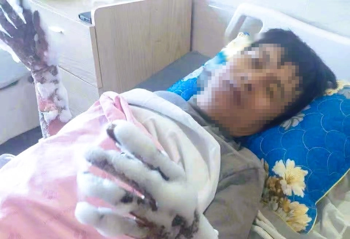 Thanh Hóa thông tin vụ nam công nhân bị điện phóng bỏng nặng 2 tay