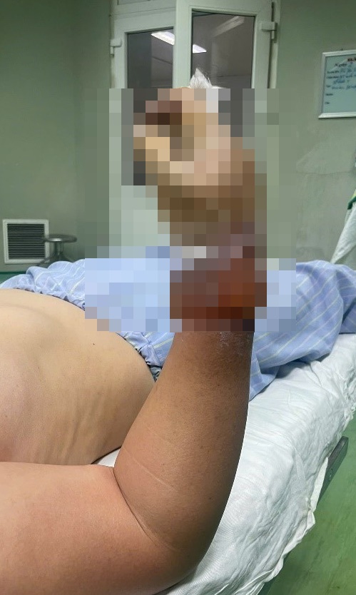 Dựng cây nêu vướng dây điện, người phụ nữ nguy cơ mất cẳng tay