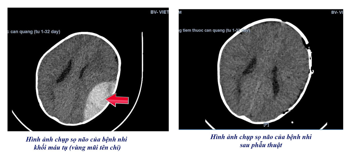 Ngã xe tập đi trẻ 8 tháng tuổi mở sọ cấp cứu giành lại sự sống