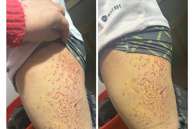 Xác định nguyên nhân nữ sinh lớp 7 ở Lào Cai bị bạn dùng bút đâm vào đùi