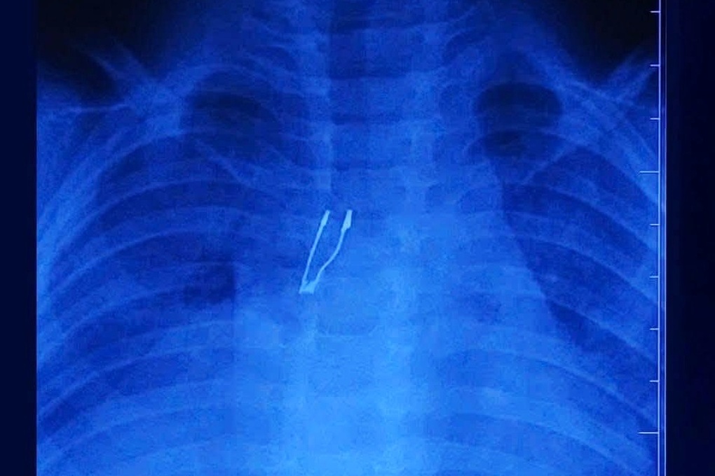 TPHCM: Bé gái 9 tháng tuổi nuốt bóng đèn LED, nhập viện nguy kịch - 1