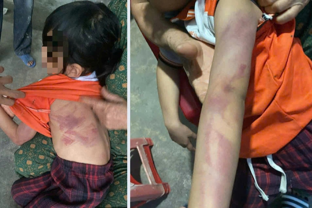 Bé gái lớp 2 bị bạn đánh bầm tím da vì lời hứa cho kẹo - 1