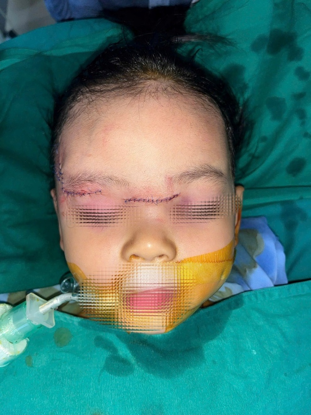 Bé gái 22 tháng tuổi tổn thương nghiêm trọng vùng mặt do chó cắn - 1