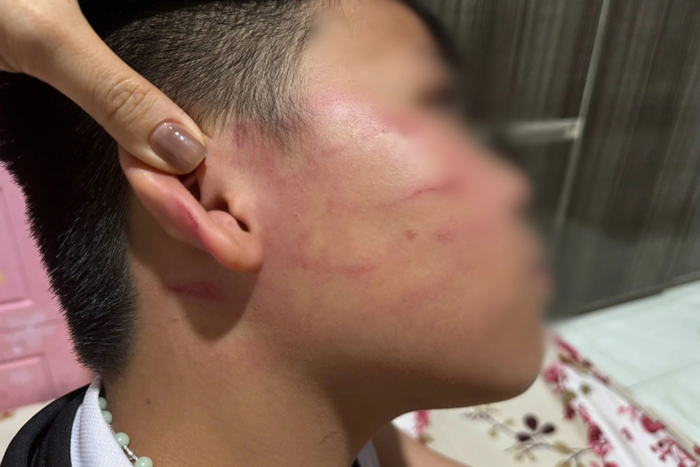 Nam sinh 9 tuổi nghi bị giáo viên dạy thêm đánh bầm mặt, ù tai - 1