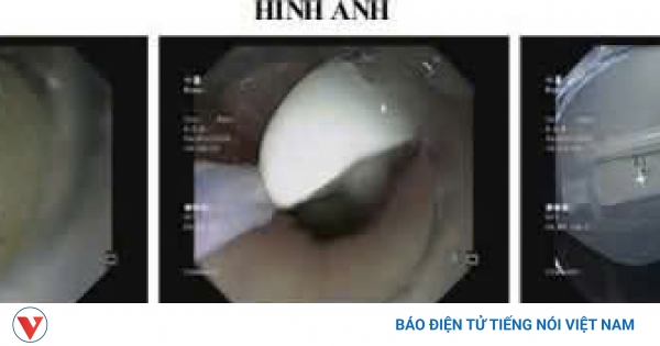 Suýt thủng dạ dày vì sự cố nuốt bàn chải đánh răng khi vệ sinh lưỡi