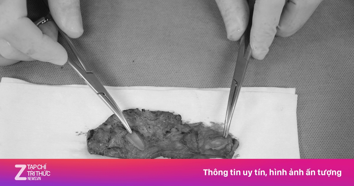 Người đàn ông hỏng vùng kín, vỡ mộng tăng kích cỡ bằng silicon
